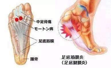 跑者四大痛之首 足底筋膜炎